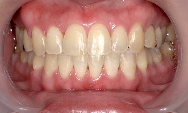 部分矯正 上下の部分矯正の症例写真