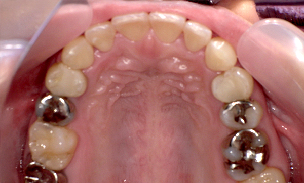 部分矯正 上下の部分矯正の症例写真