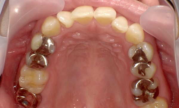 部分矯正 上下の部分矯正の症例写真