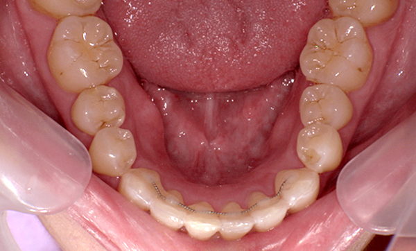 部分矯正 上下の部分矯正の症例写真