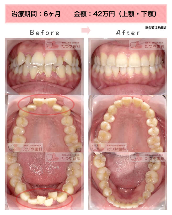 部分矯正の症例　上下の前歯