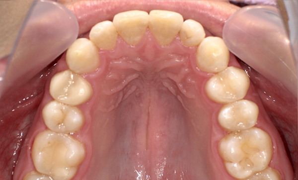 部分矯正 上下の部分矯正の症例写真