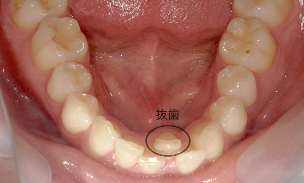 部分矯正 上下の部分矯正の症例写真