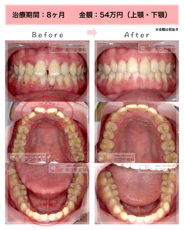 部分矯正の症例　上下の前歯