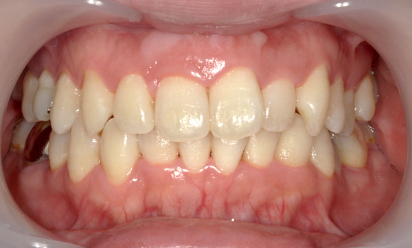 部分矯正 上下の部分矯正の症例写真