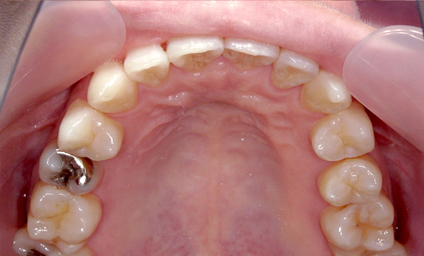 部分矯正 上下の部分矯正の症例写真