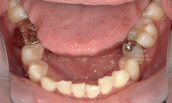 部分矯正 上下の部分矯正の症例写真