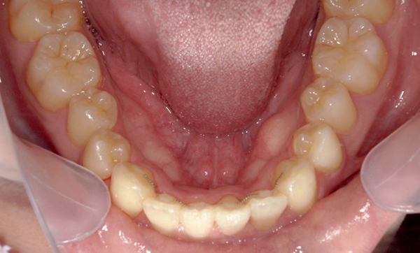部分矯正 上下の部分矯正の症例写真