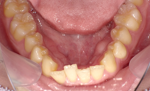 部分矯正 上下の部分矯正の症例写真