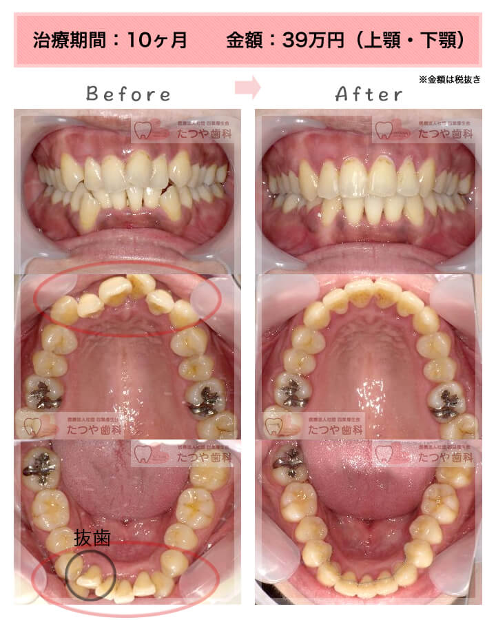 部分矯正の症例　上下の前歯