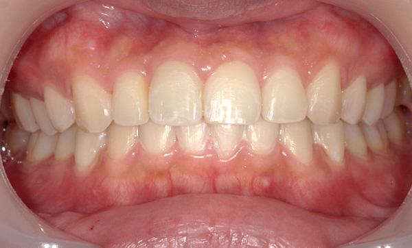 部分矯正 上下の部分矯正の症例写真