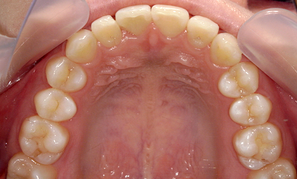 部分矯正 上下の部分矯正の症例写真