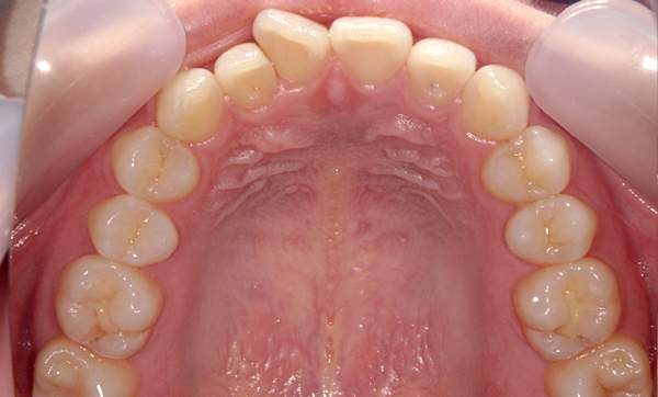 部分矯正 上下の部分矯正の症例写真