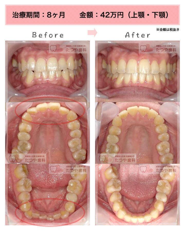 部分矯正の症例　上下の前歯