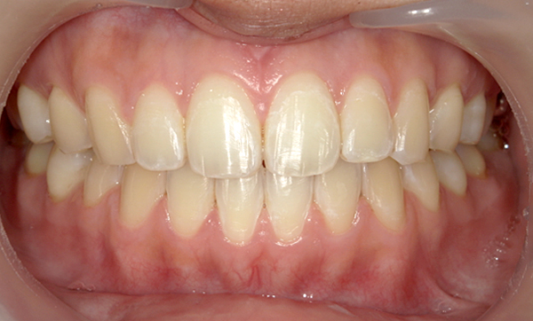 部分矯正 上下の部分矯正の症例写真