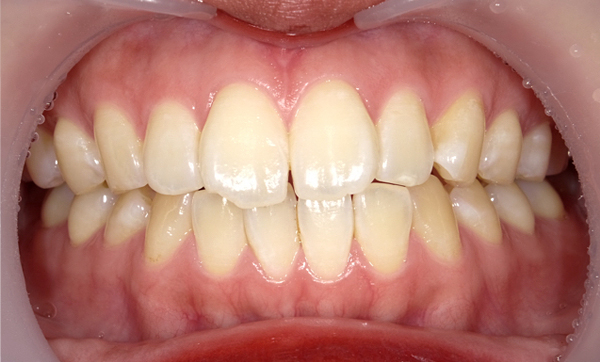 部分矯正 上下の部分矯正の症例写真