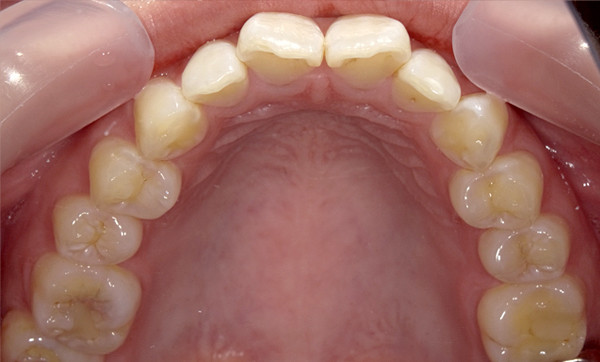 部分矯正 上下の部分矯正の症例写真