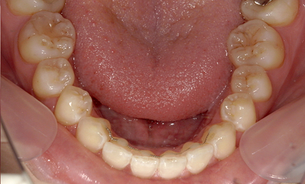 部分矯正 上下の部分矯正の症例写真