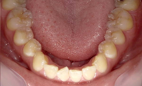 部分矯正 上下の部分矯正の症例写真