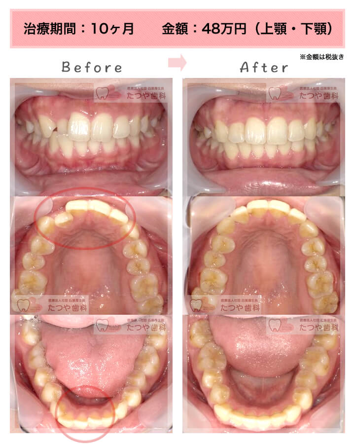 部分矯正の症例　上下の前歯