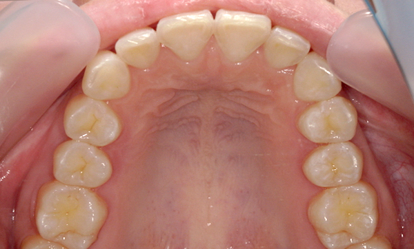 部分矯正 上下の部分矯正の症例写真