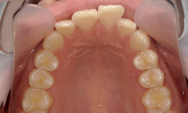 部分矯正 上下の部分矯正の症例写真