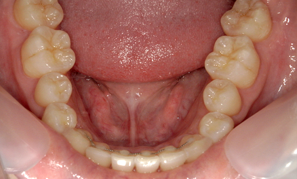 部分矯正 上下の部分矯正の症例写真