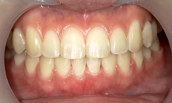 部分矯正 上下の部分矯正の症例写真