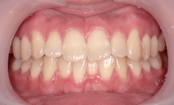 部分矯正 上下の部分矯正の症例写真