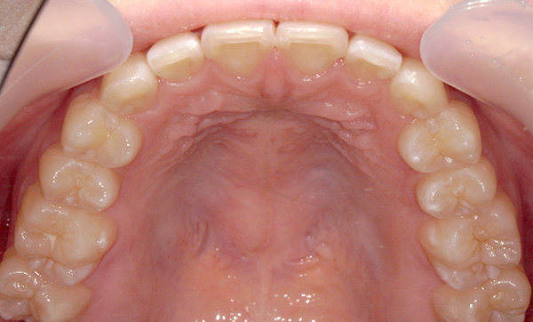 部分矯正 上下の部分矯正の症例写真