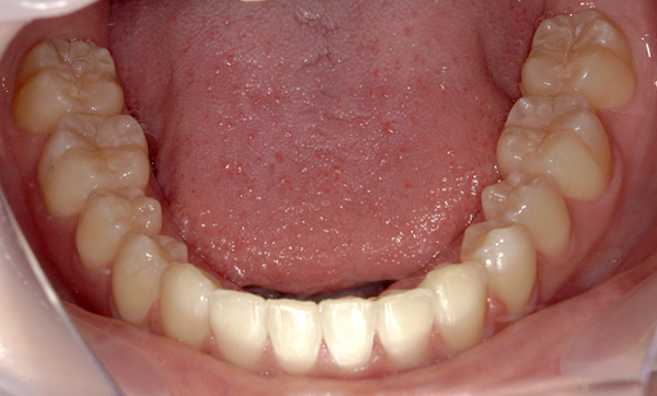 部分矯正 上下の部分矯正の症例写真