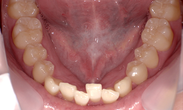 部分矯正 上下の部分矯正の症例写真