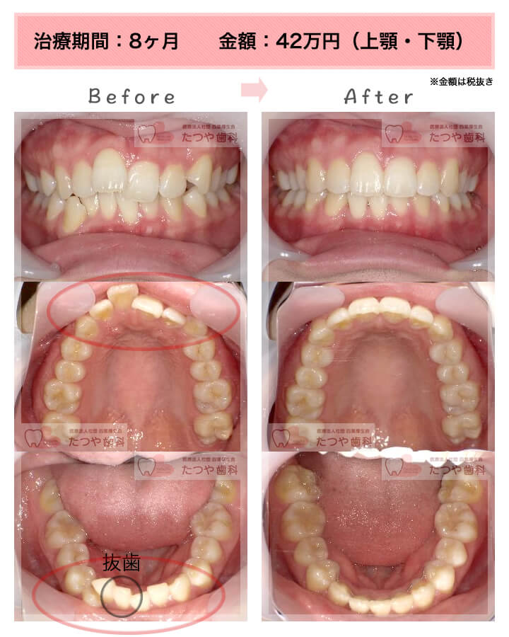 部分矯正の症例　上下の前歯