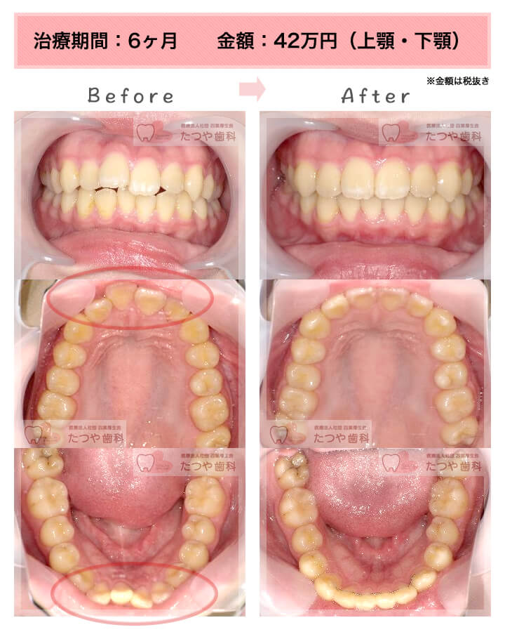 部分矯正の症例　上下の前歯