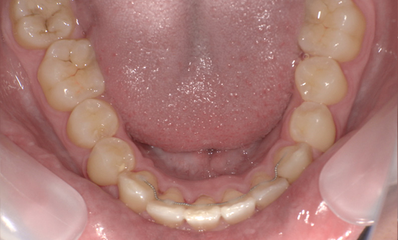 部分矯正 上下の部分矯正の症例写真