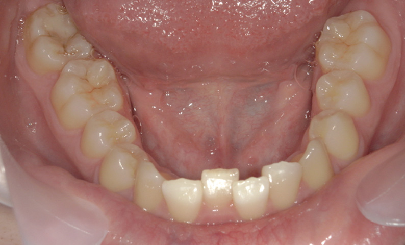 部分矯正 上下の部分矯正の症例写真