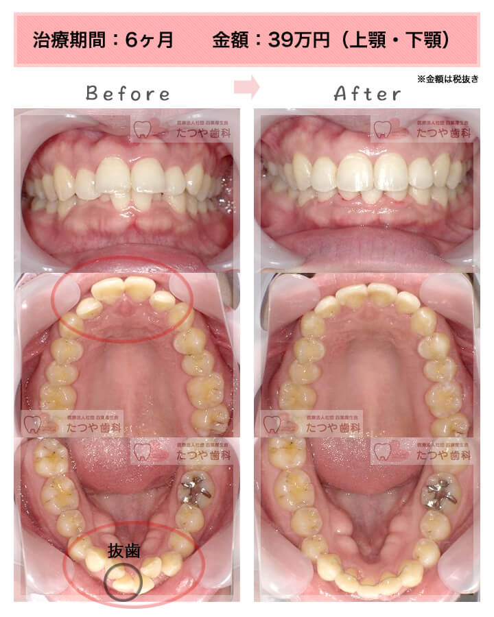 部分矯正の症例　上下の前歯
