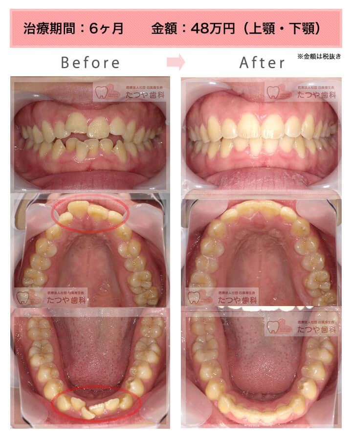 部分矯正の症例　上下の前歯