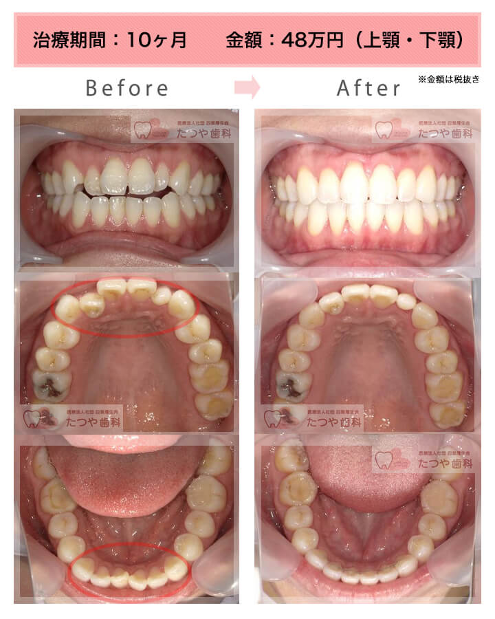 部分矯正の症例　上下の前歯