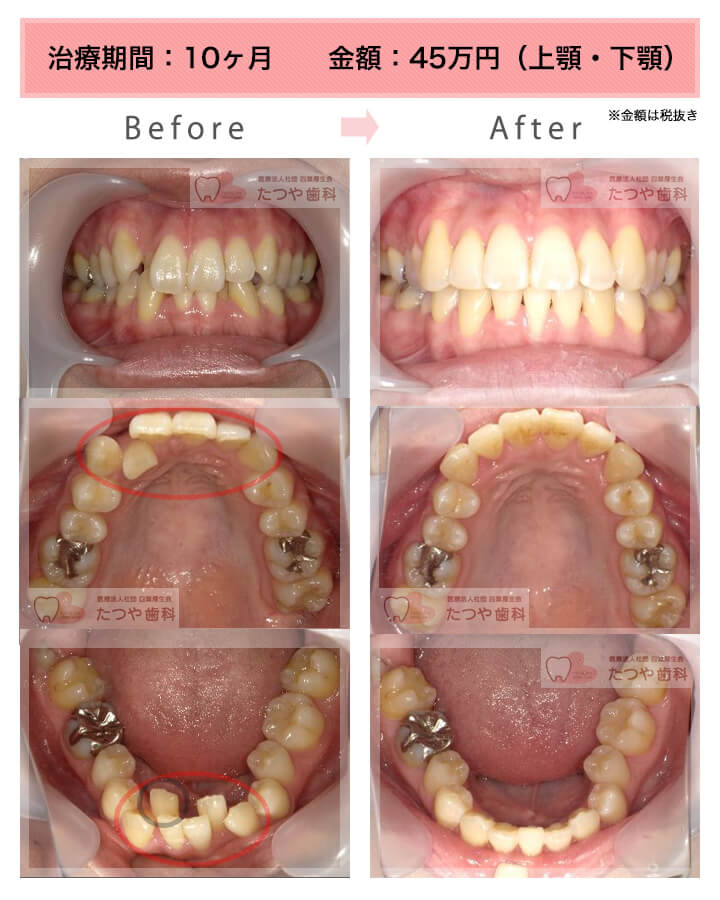 部分矯正の症例　上下の前歯