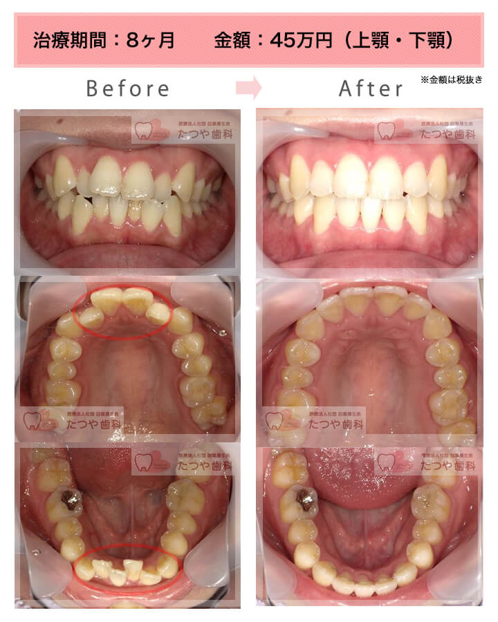 部分矯正の症例　上下の前歯