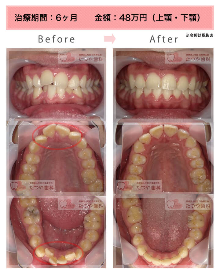 部分矯正の症例　上下の前歯