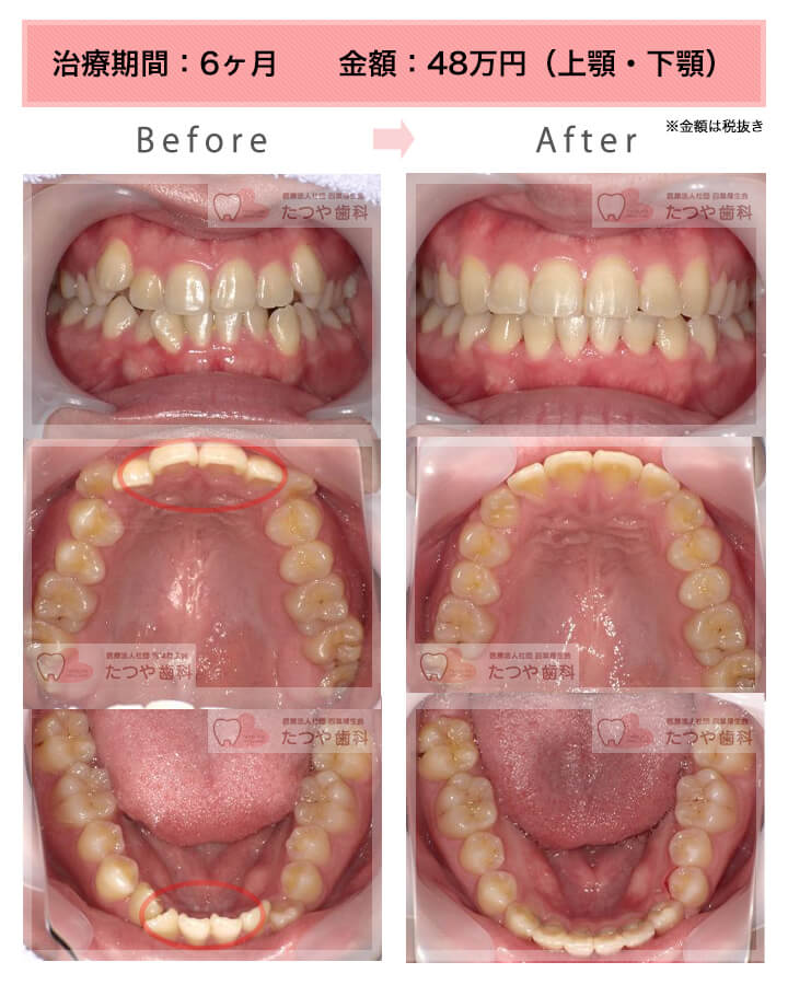 部分矯正の症例　上下の前歯