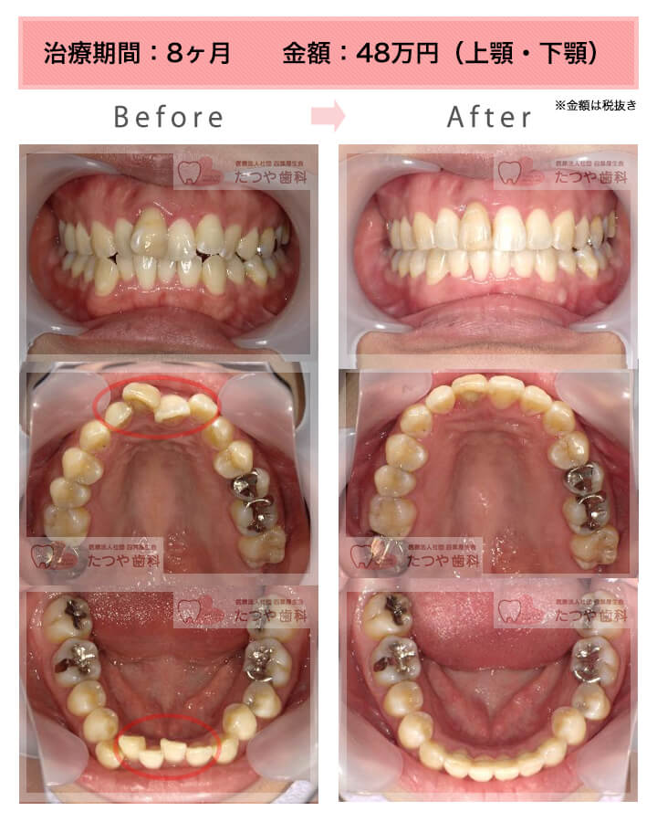 部分矯正の症例　上下の前歯