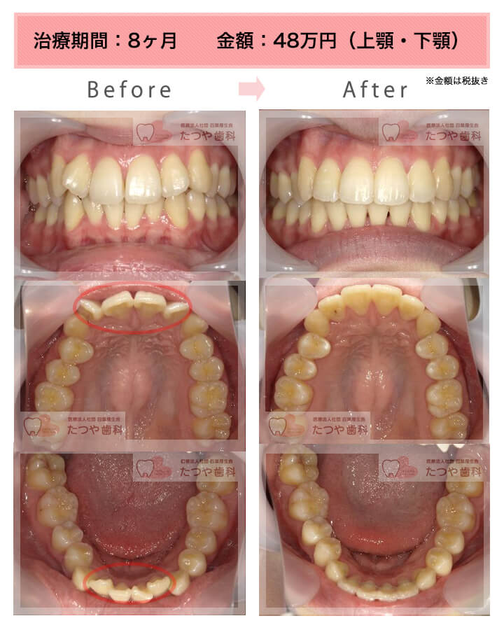 部分矯正の症例　上下の前歯