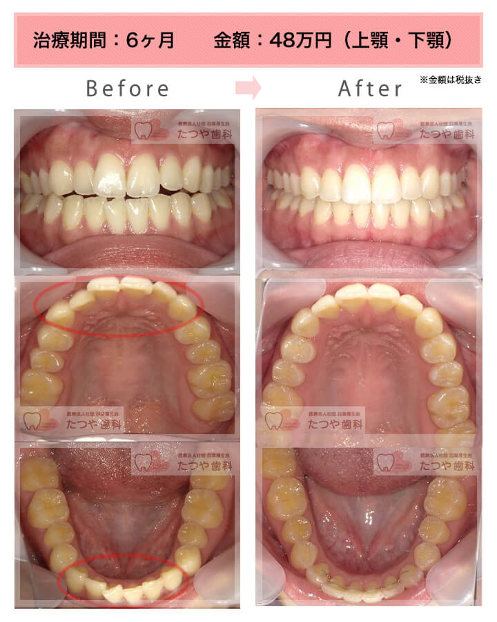 部分矯正の症例　上下の前歯