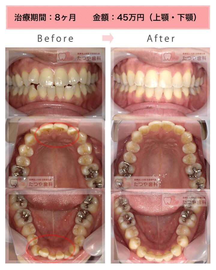 部分矯正の症例　上下の前歯