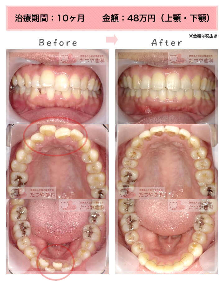 部分矯正の症例　上下の前歯