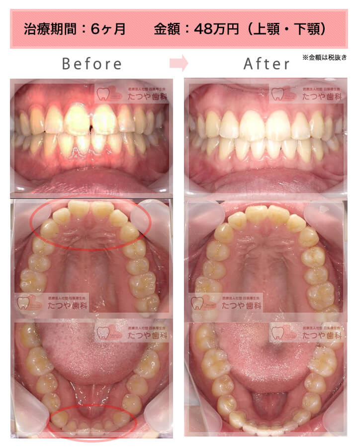部分矯正の症例　上下の前歯