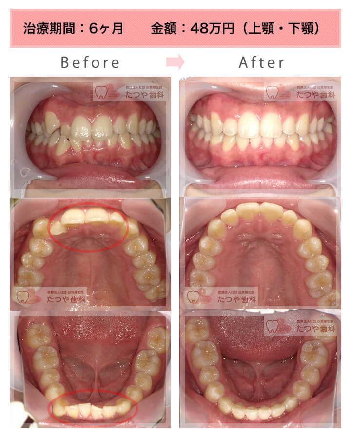 部分矯正の症例　上下の前歯